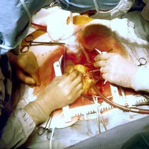 A Case of Open Heart Surgery